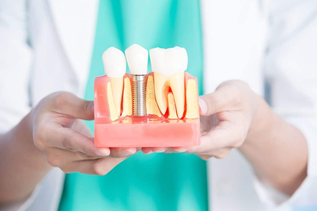 4 Myths About Dental Implants